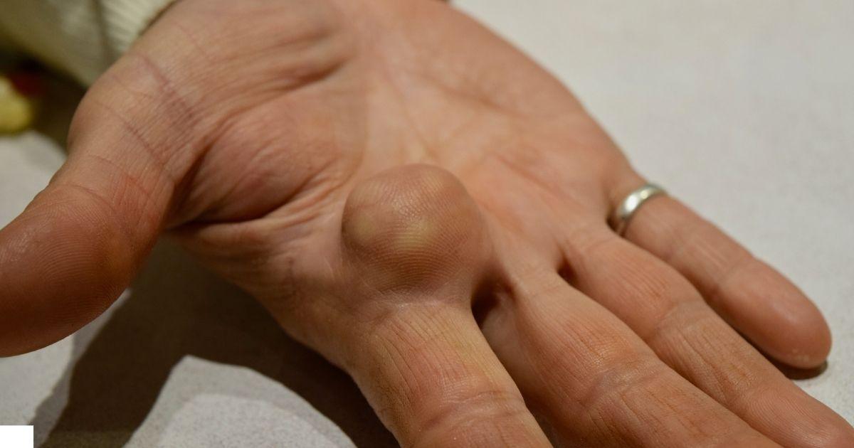 लिपोमा (गांठ) क्या है? कारण, लक्षण, इलाज और आयुर्वेदिक जीवनशैली गाइड